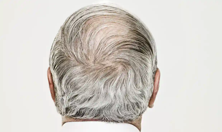 Scientists Discover Why Hair Turns Gray